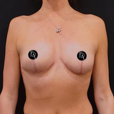 Breast Reduction Before & After Gallery - Patient 386259 - Image 2