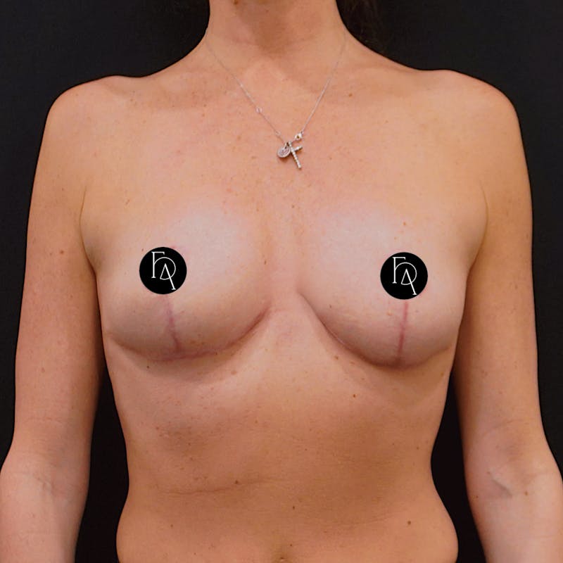 Breast Reduction Before & After Gallery - Patient 386259 - Image 2