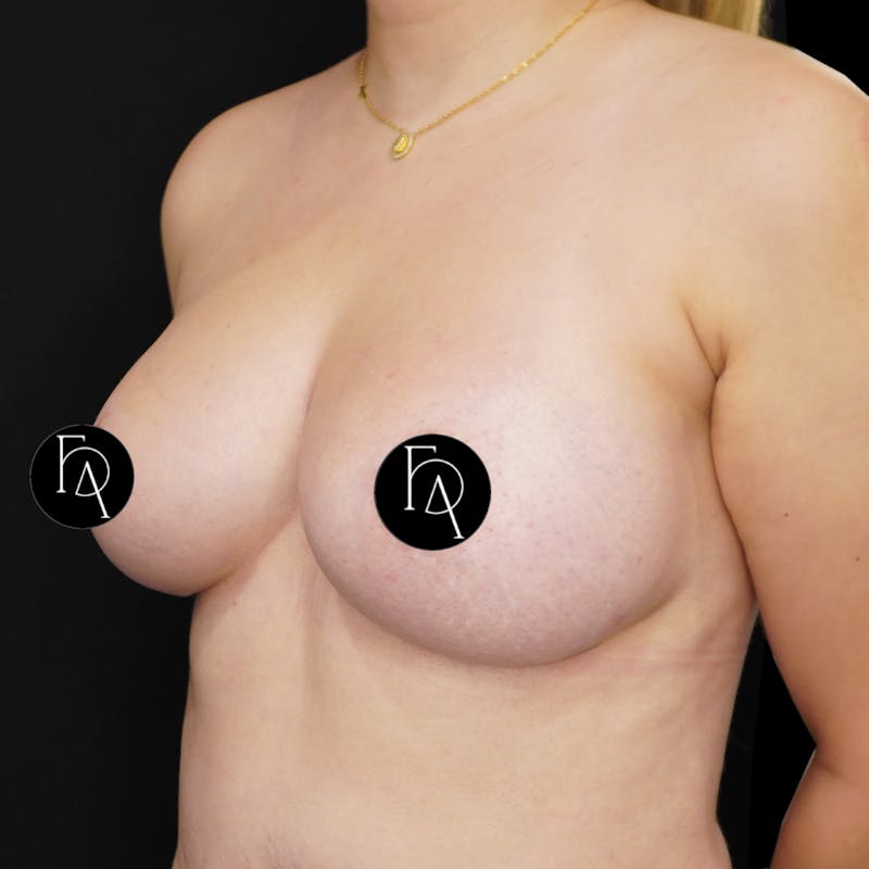 Breast Implant Removal Before & After Gallery - Patient 196703 - Image 3