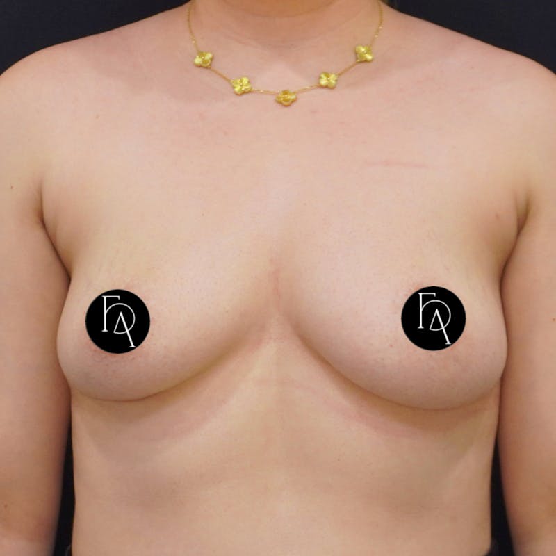 Breast Implant Removal Before & After Gallery - Patient 196703 - Image 2