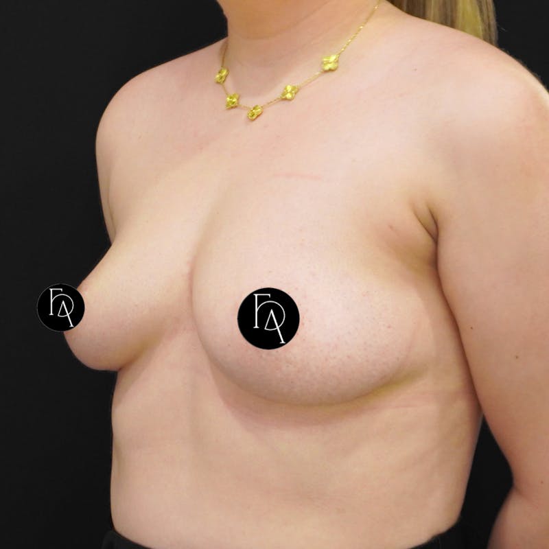 Breast Implant Removal Before & After Gallery - Patient 196703 - Image 4