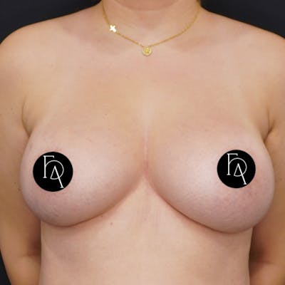 Breast Implant Removal Before & After Gallery - Patient 196703 - Image 1