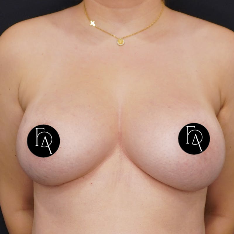 Breast Implant Removal Before & After Gallery - Patient 196703 - Image 1