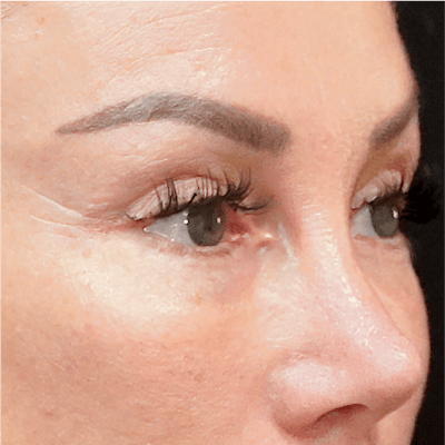 Alloclae-adipose Filler Before & After Gallery - Patient 141784 - Image 2