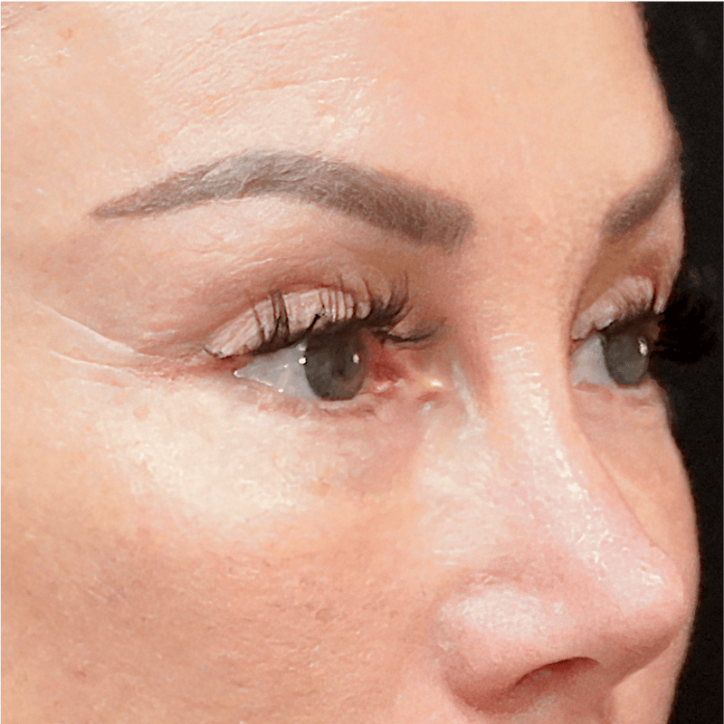 Alloclae-adipose Filler Before & After Gallery - Patient 141784 - Image 2