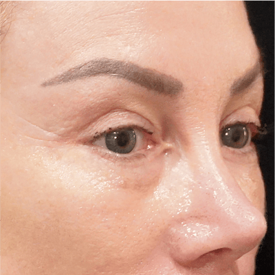 Alloclae-adipose Filler Before & After Gallery - Patient 141784 - Image 1