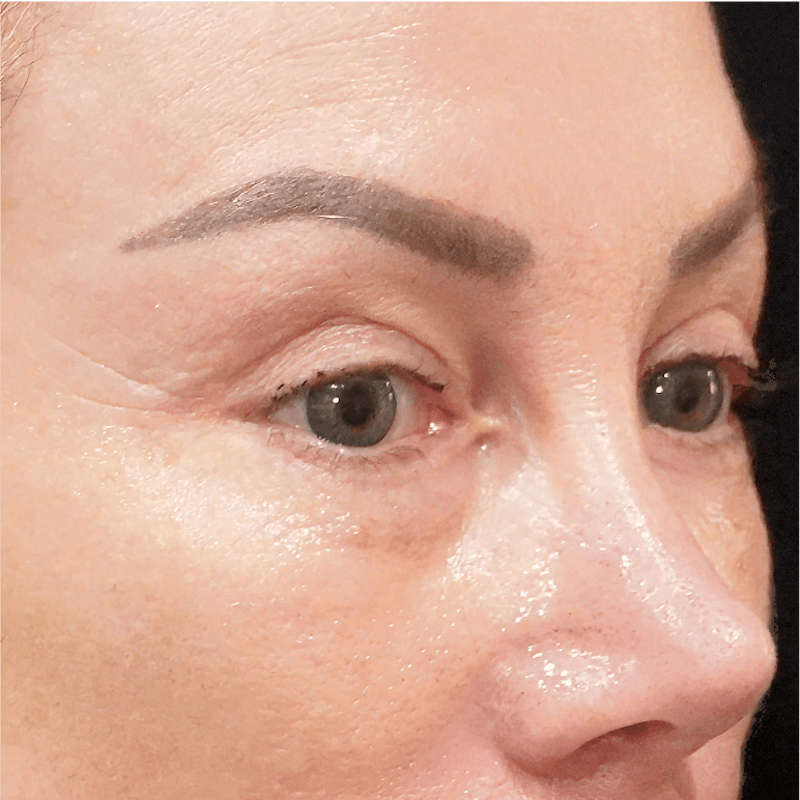 Alloclae-adipose Filler Before & After Gallery - Patient 141784 - Image 1