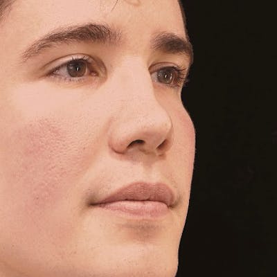 Alloclae-adipose Filler Before & After Gallery - Patient 400385 - Image 2