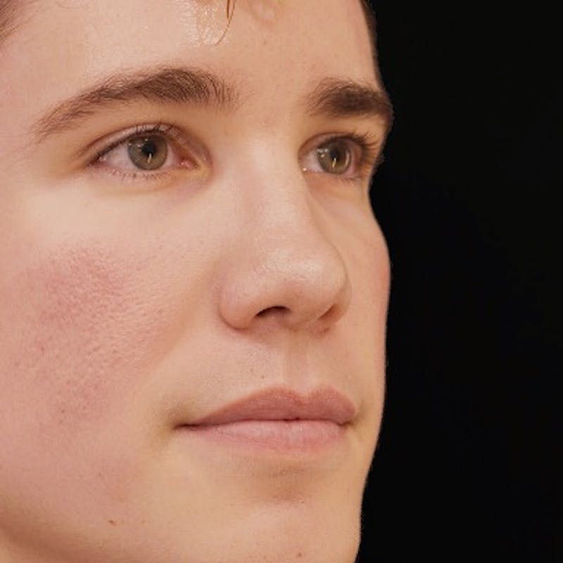 Alloclae-adipose Filler Before & After Gallery - Patient 400385 - Image 1