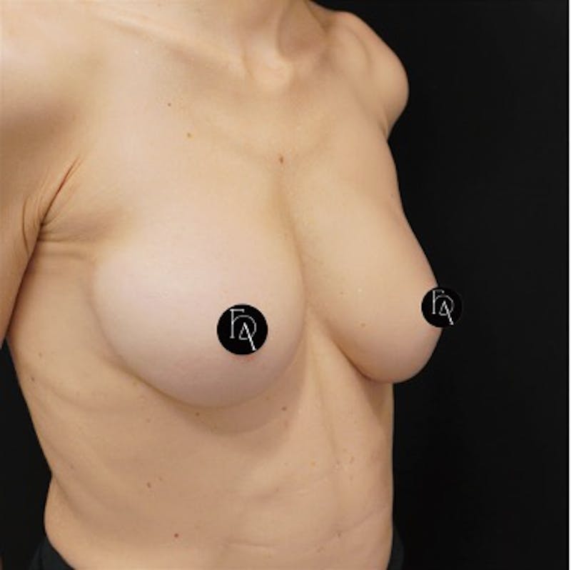 Alloclae-adipose Filler Before & After Gallery - Patient 228287 - Image 4