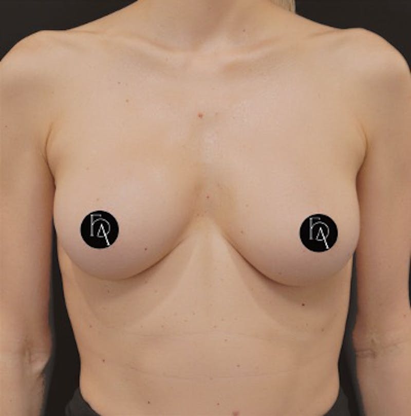 Alloclae-adipose Filler Before & After Gallery - Patient 228287 - Image 2