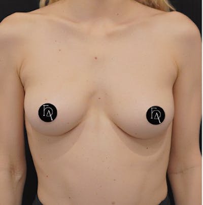 Alloclae-adipose Filler Before & After Gallery - Patient 228287 - Image 1