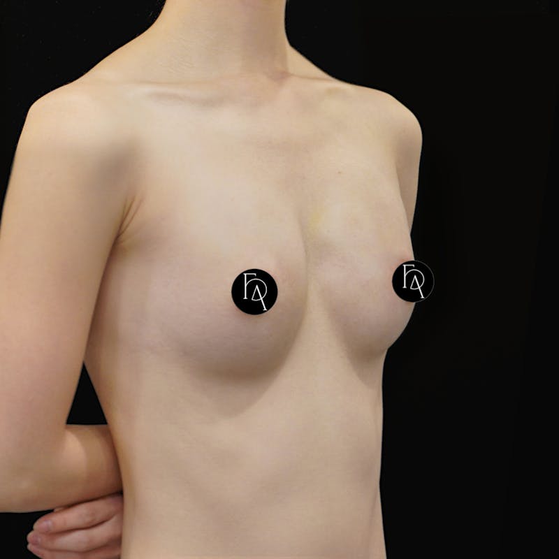 Alloclae-adipose Filler Before & After Gallery - Patient 366093 - Image 4