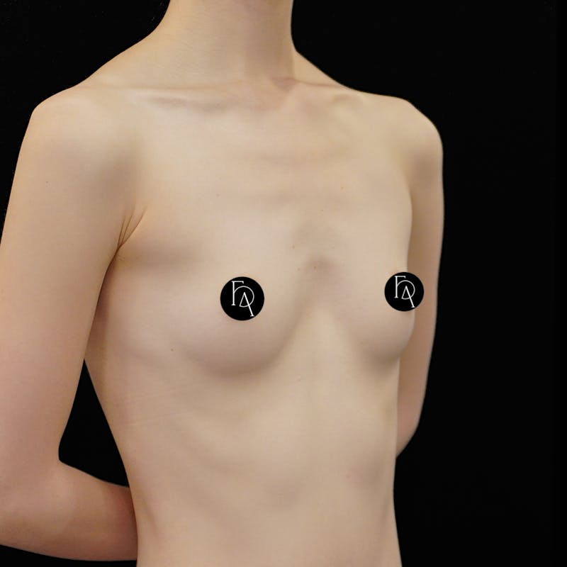 Alloclae-adipose Filler Before & After Gallery - Patient 366093 - Image 3