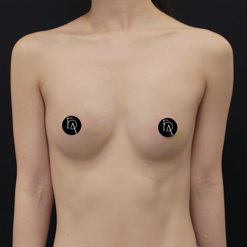 Alloclae-adipose Filler Before & After Gallery - Patient 366093 - Image 2