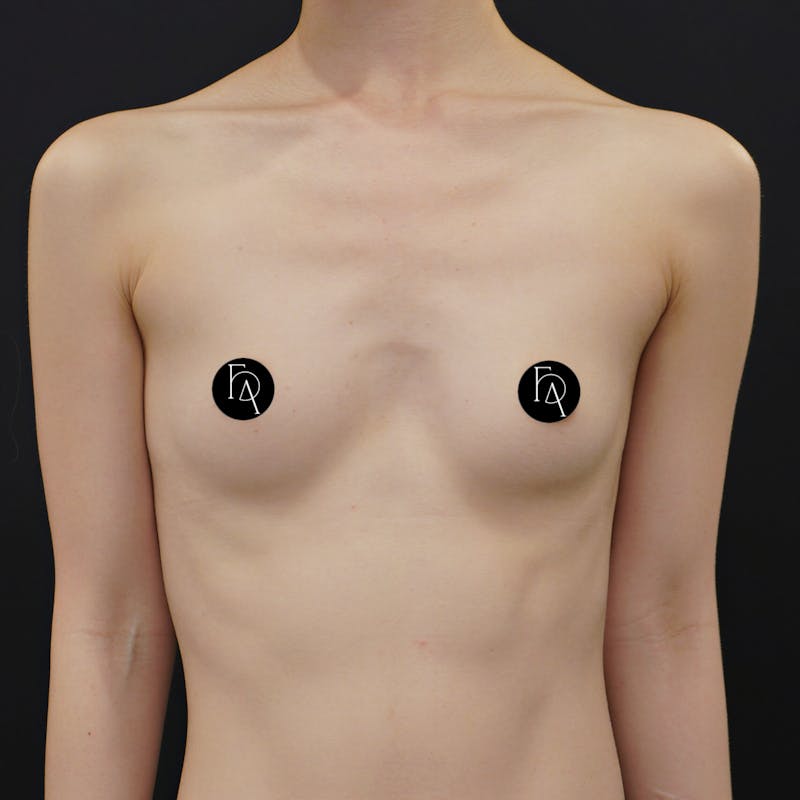 Alloclae-adipose Filler Before & After Gallery - Patient 366093 - Image 1