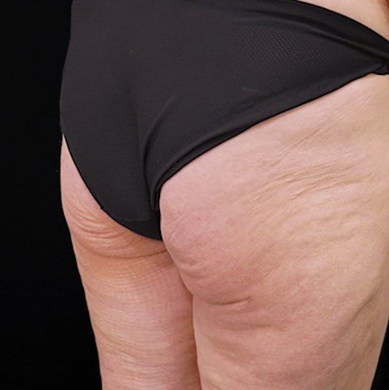 Alloclae-adipose Filler Before & After Gallery - Patient 382835 - Image 4