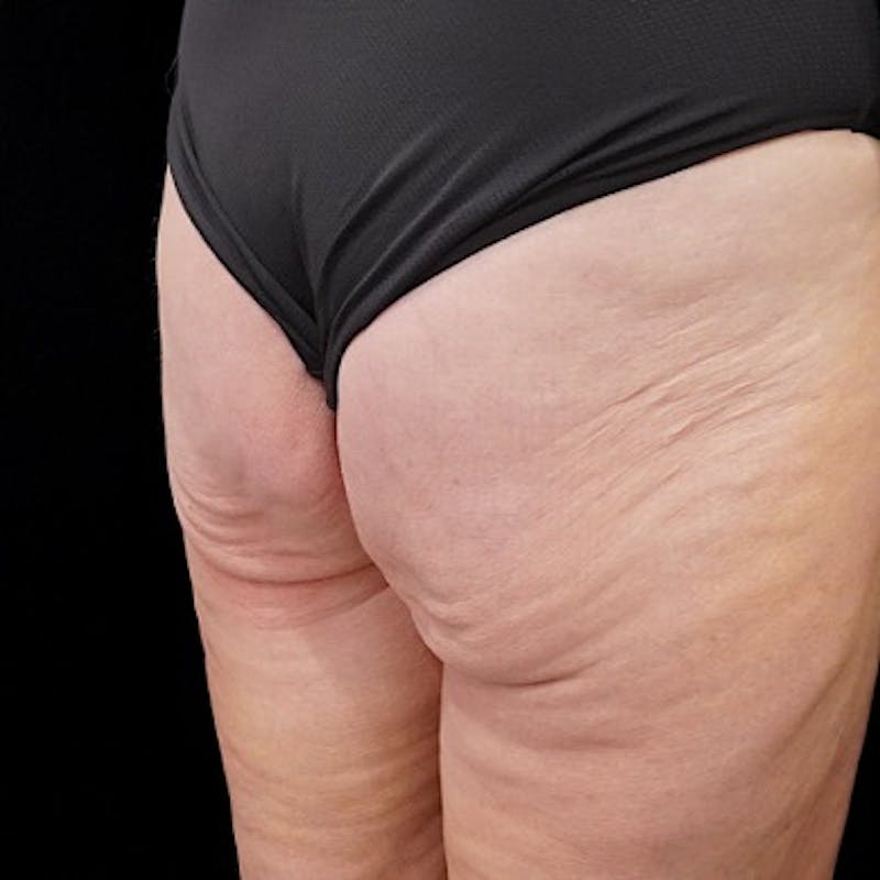 Alloclae-adipose Filler Before & After Gallery - Patient 382835 - Image 3