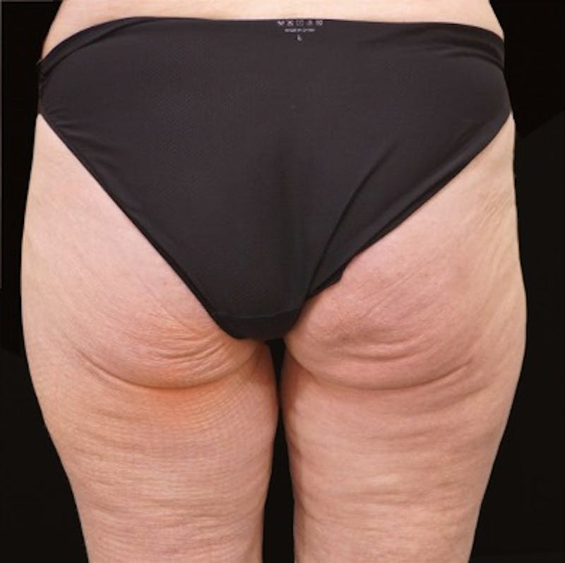 Alloclae-adipose Filler Before & After Gallery - Patient 382835 - Image 2