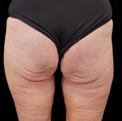 Alloclae-adipose Filler Before & After Gallery - Patient 382835 - Image 1