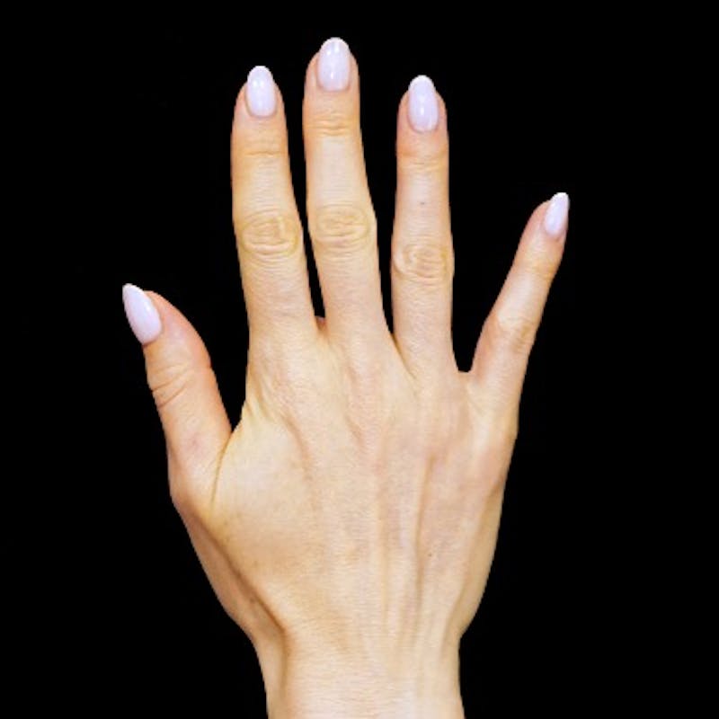 Alloclae-adipose Filler Before & After Gallery - Patient 128283 - Image 1