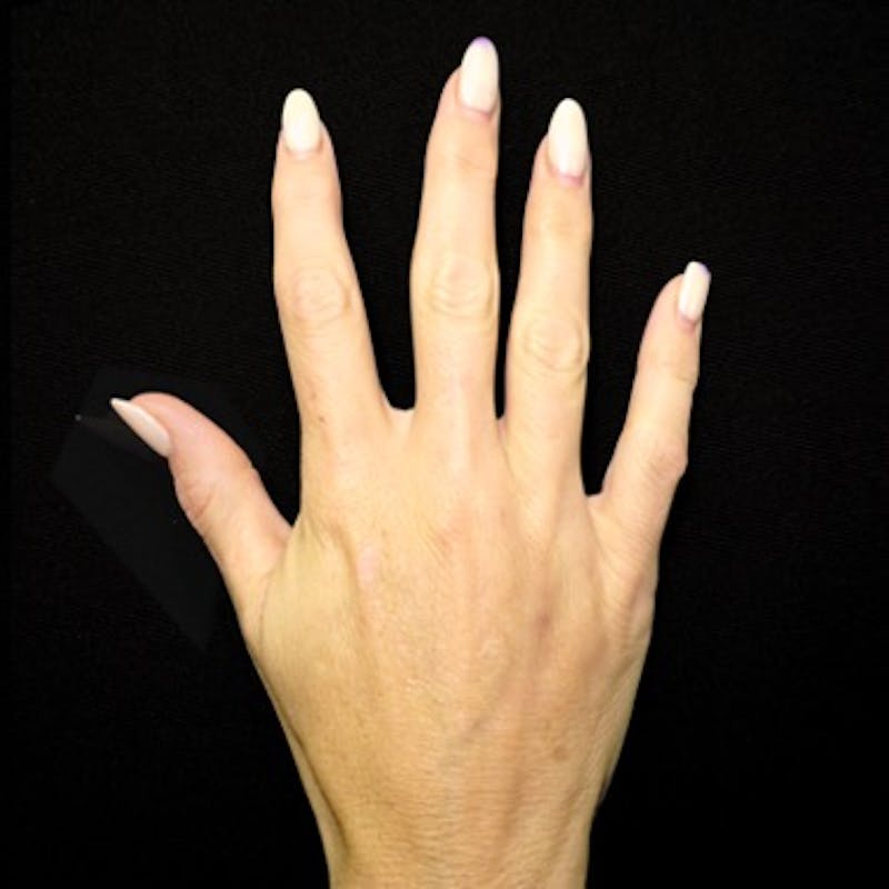 Alloclae-adipose Filler Before & After Gallery - Patient 272753 - Image 2