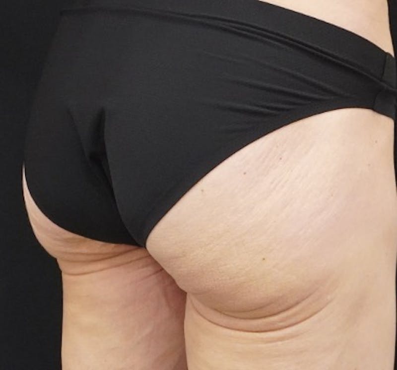 Alloclae-adipose Filler Before & After Gallery - Patient 260666 - Image 3