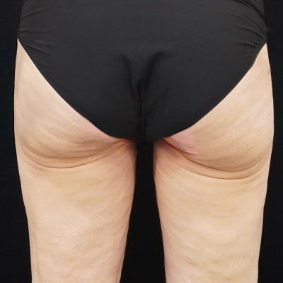 Alloclae-adipose Filler Before & After Gallery - Patient 260666 - Image 1