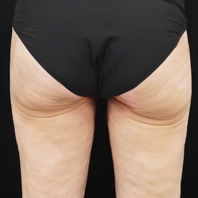 Alloclae-adipose Filler Before & After Gallery - Patient 260666 - Image 1