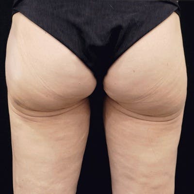 Alloclae-adipose Filler Before & After Gallery - Patient 260666 - Image 2