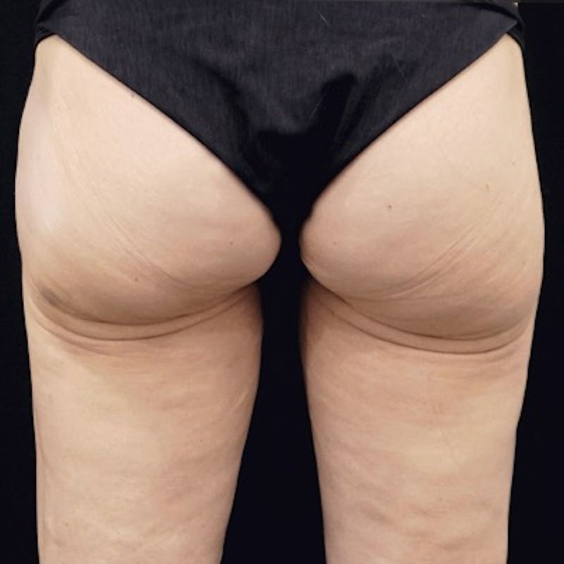 Alloclae-adipose Filler Before & After Gallery - Patient 260666 - Image 2