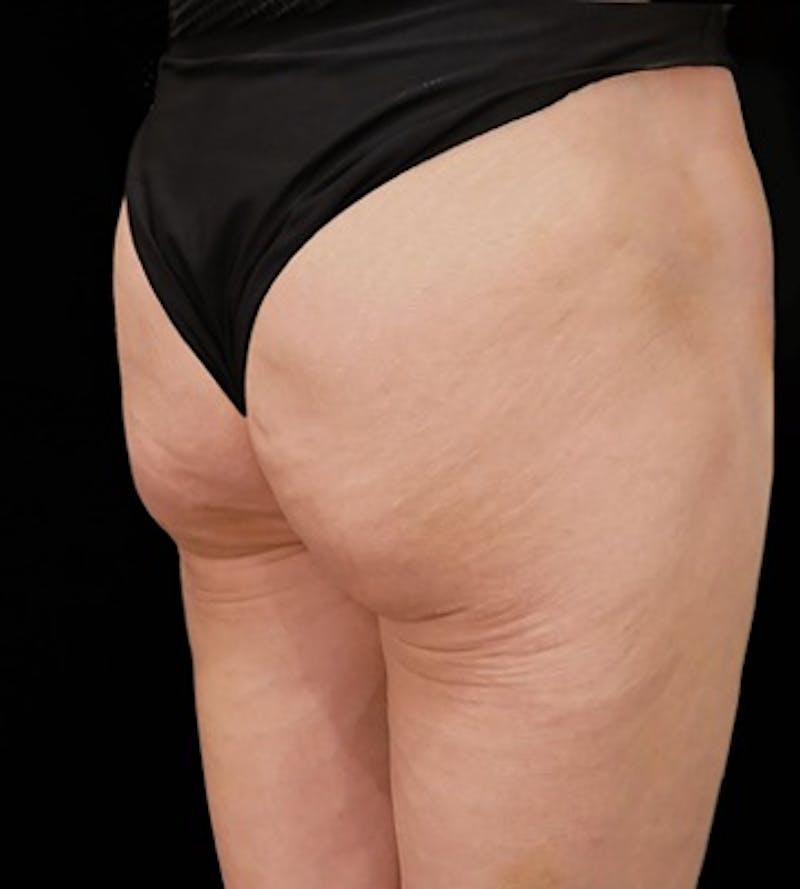 Alloclae-adipose Filler Before & After Gallery - Patient 320859 - Image 4