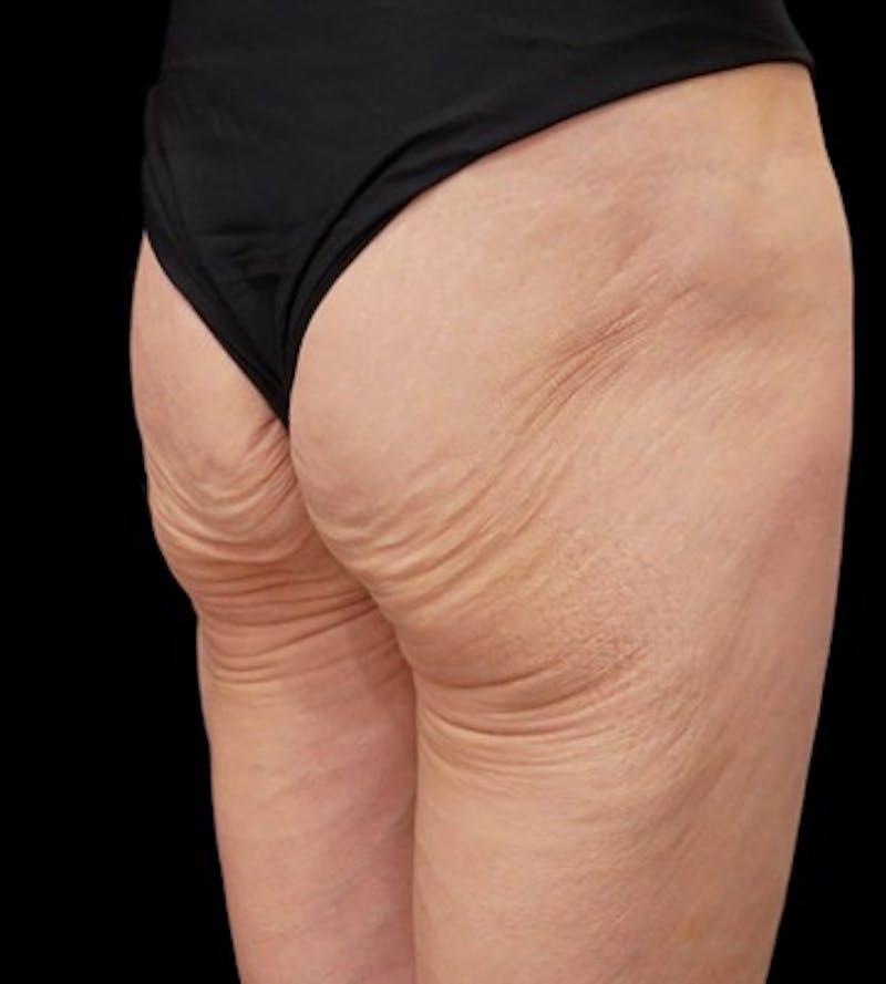 Alloclae-adipose Filler Before & After Gallery - Patient 320859 - Image 3