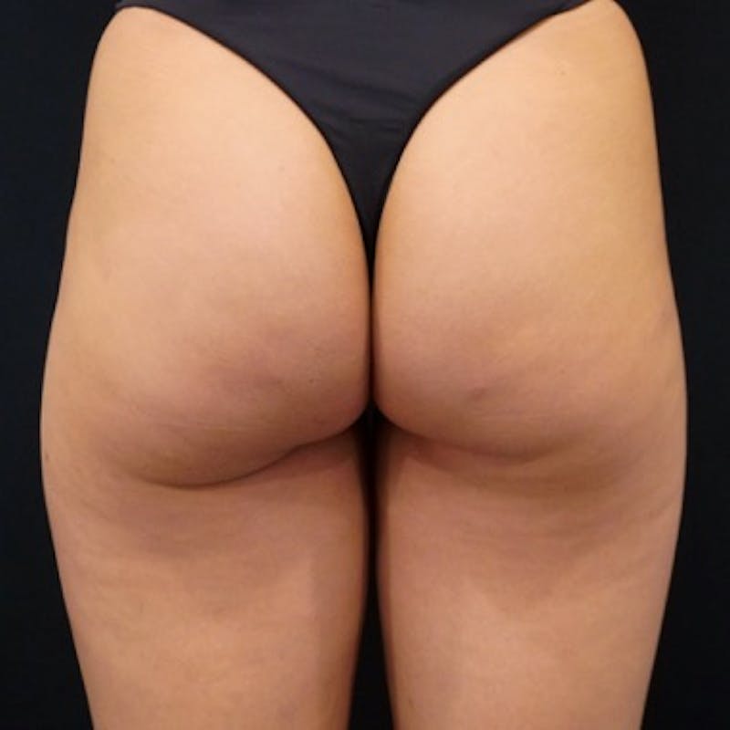 Alloclae-adipose Filler Before & After Gallery - Patient 405619 - Image 2
