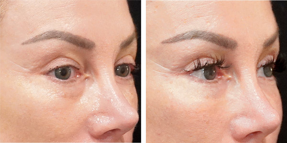 Alloclae-adipose Filler - Face Before & After Gallery - Patient 141784 - Image 1