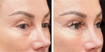 Alloclae-adipose Filler - Face Before & After Gallery - Patient 141784 - Image 1