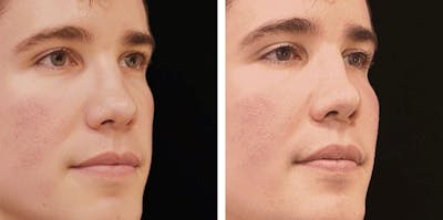 Alloclae-adipose Filler - Face Before & After Gallery - Patient 400385 - Image 1