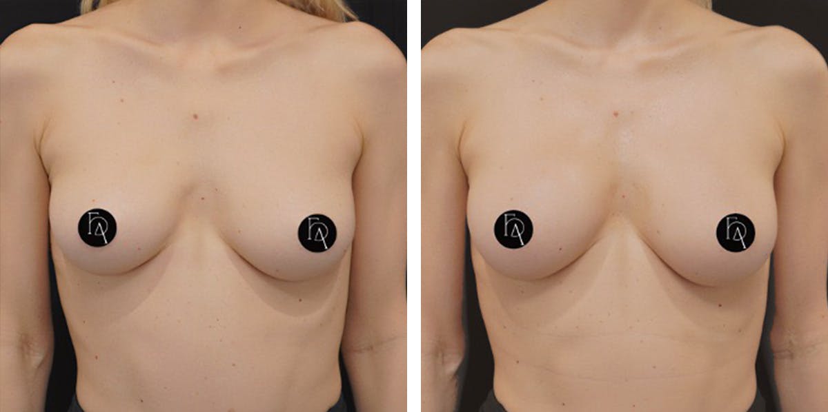 Alloclae-adipose Filler - Breast Before & After Gallery - Patient 228287 - Image 1