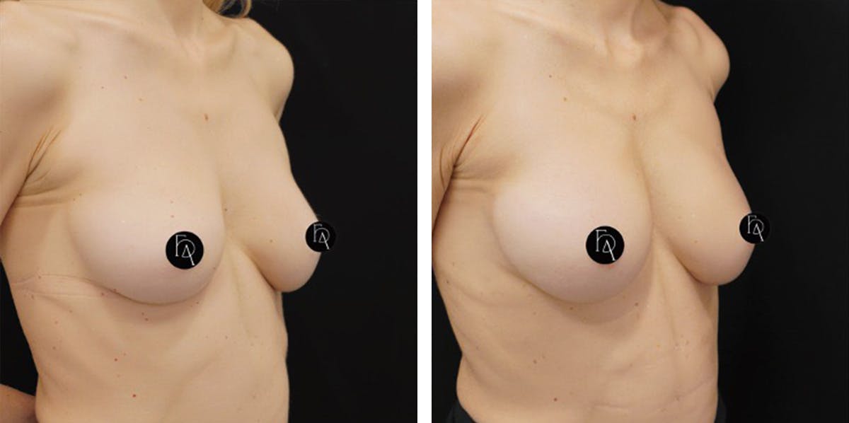 Alloclae-adipose Filler - Breast Before & After Gallery - Patient 228287 - Image 2