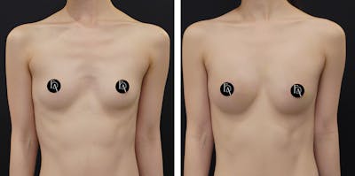 Alloclae-adipose Filler - Breast Before & After Gallery - Patient 366093 - Image 1
