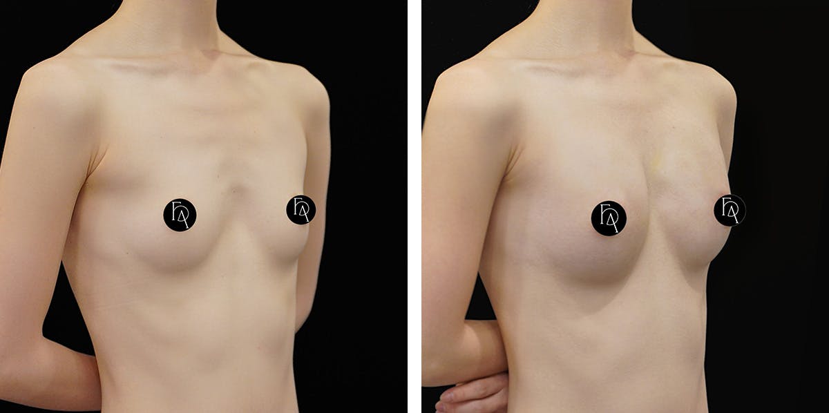 Alloclae-adipose Filler - Breast Before & After Gallery - Patient 366093 - Image 2