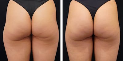 Alloclae-adipose Filler - Body Before & After Gallery - Patient 405619 - Image 1