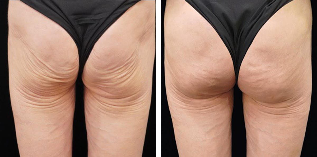 Alloclae-adipose Filler - Body Before & After Gallery - Patient 320859 - Image 1