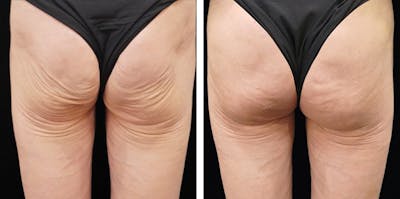 Alloclae-adipose Filler - Body Before & After Gallery - Patient 320859 - Image 1