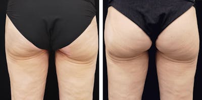 Alloclae-adipose Filler - Body Before & After Gallery - Patient 260666 - Image 1