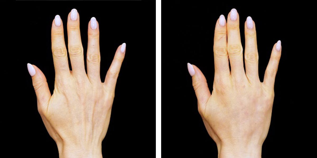 Alloclae-adipose Filler - Body Before & After Gallery - Patient 128283 - Image 1