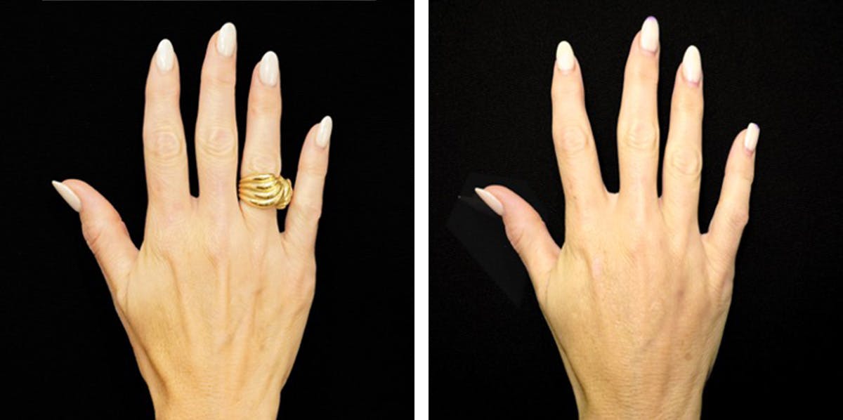 Alloclae-adipose Filler - Body Before & After Gallery - Patient 272753 - Image 1