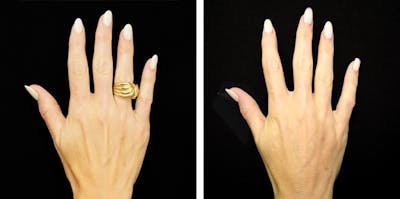 Alloclae-adipose Filler - Body Before & After Gallery - Patient 272753 - Image 1