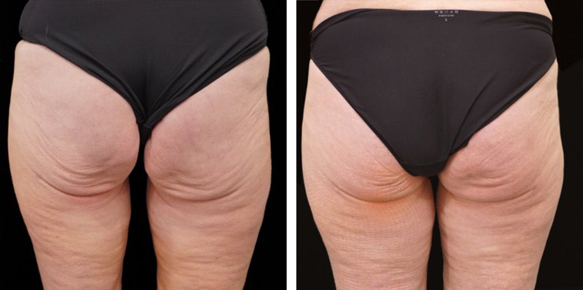 Alloclae-adipose Filler - Body Before & After Gallery - Patient 382835 - Image 1