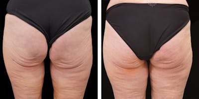 Alloclae-adipose Filler - Body Before & After Gallery - Patient 382835 - Image 1